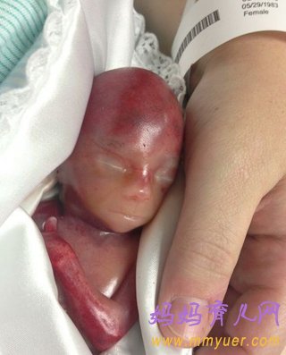 美国妈妈产下19周早产儿 看着就揪心（图片）