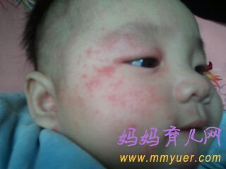 新生儿脸上有小红点是怎么回事？