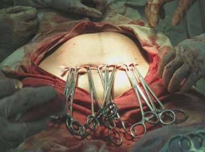 剖腹产分娩全过程（视频截图）