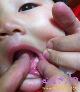 宝宝长牙牙龈变化（图片）