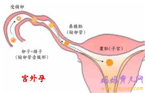 主页 怀孕 孕检 > 找准宫外孕的病因 不让怀孕空  1,输卵管手术 曾患