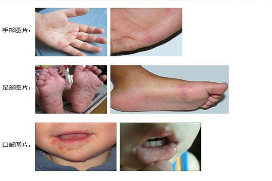 手足口病刚开始的图片看看你家孩子是否有这症状