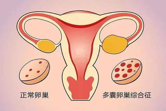【亲】多囊卵巢最快受孕方法 第4种方法最直接了当