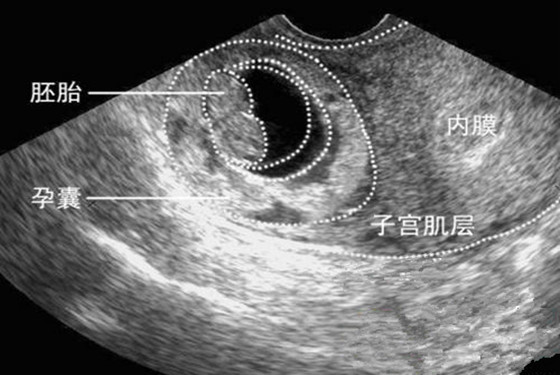 主页 怀孕 生男生女 > 怀女宝宝的12种早知道  2,孕囊形状:早期孕囊