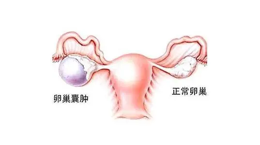 早期卵巢囊肿五大症状