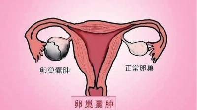 卵巢囊肿怎么才能消除