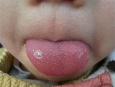 孩子舌头上草莓红点