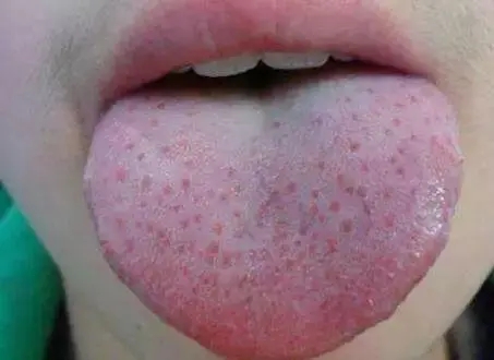 孩子舌头上草莓红点图，孩子舌头上有草莓红点怎么处理