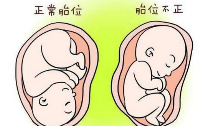 胎位不正的纠正方法图