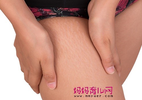 大腿妊娠纹怎么去除 试试这几种消除方法