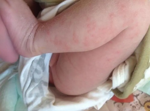 宝宝身上起湿疹日常如何护理?
