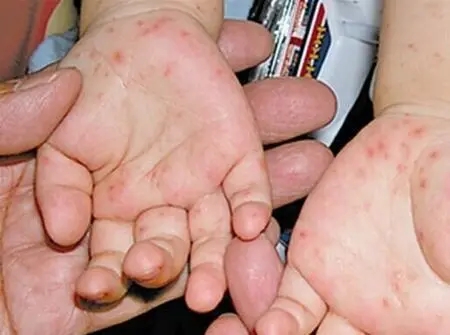 手足口病有哪些症状？会发烧吗？