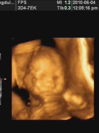 怀孕十二周胎儿高清图