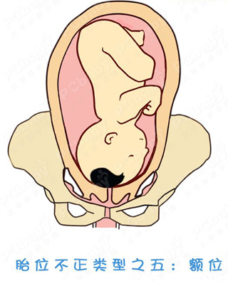 胎位不正怎么办？纠正胎位的正方法（图）