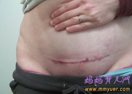 剖腹产疤痕会让妈妈的肚皮成什么样(图片)?