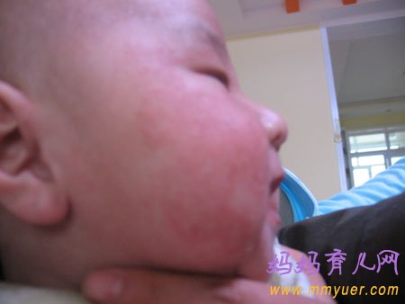 婴儿湿疹症状图片