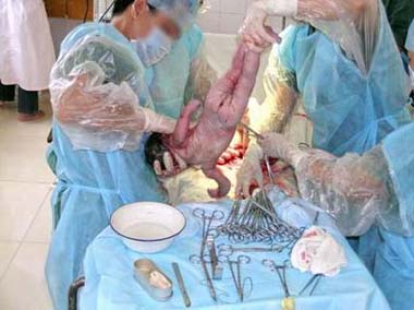 剖腹产分娩全过程视频截图3