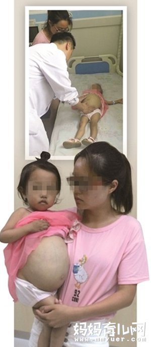 3岁女童肚子鼓如球 戈谢病治疗年超百万 