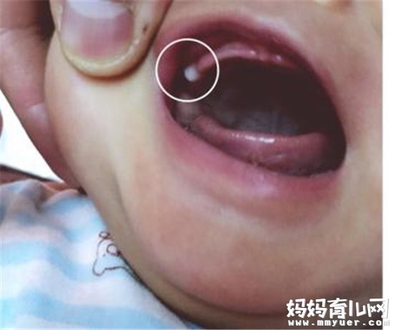 婴儿嘴巴里面长马牙图图片