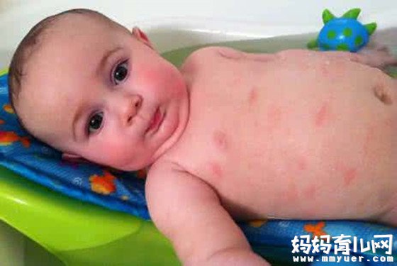 治婴幼儿湿疹最好的药膏 据说就这两种