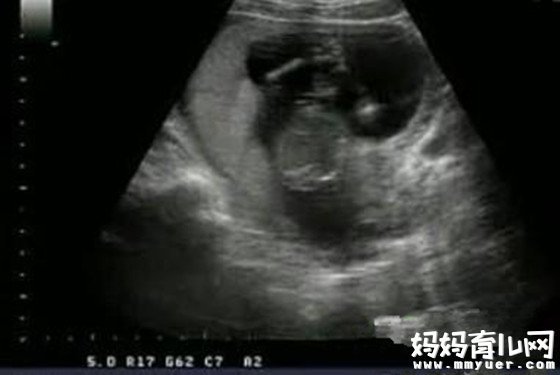 四维彩超能看男女 怀孕四个月男胎儿图长这样