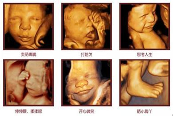 怀孕6个月四维彩超图一清二楚的看到胎儿在打哈欠
