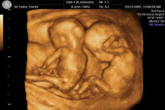 四个月双胞胎彩超图片图片