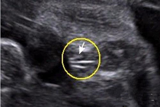 十四周胎儿性别区别图图片