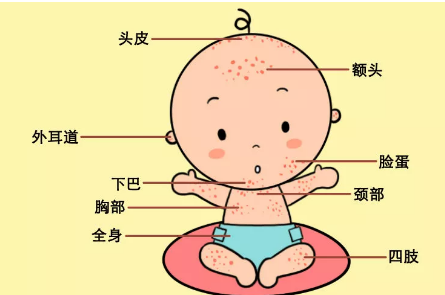 婴儿湿疹不用怕 60%的情况下用它能治好！
