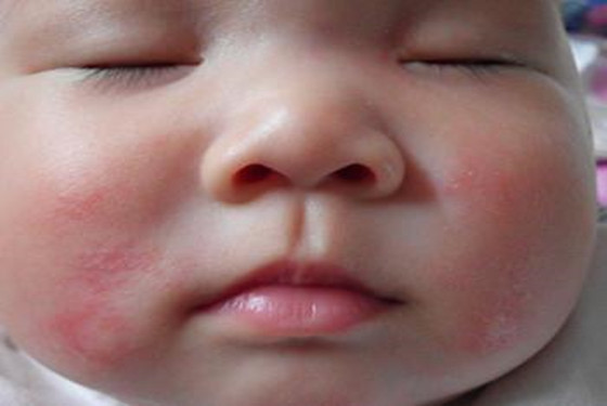 嬰兒濕疹照片