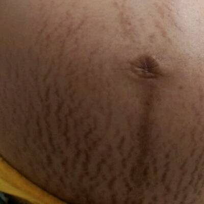 大肚子妊娠纹真实图片图片