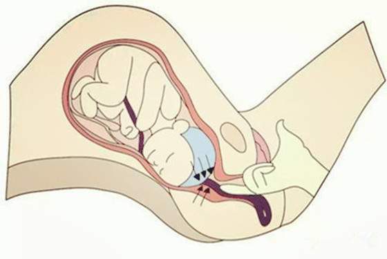 胎盘低置的姿势图片图片