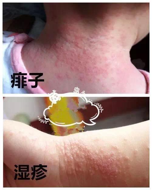 湿疹和热痱子的区别图图片