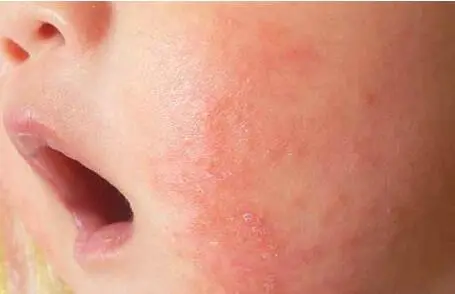 宝宝湿疹的症状有哪些？