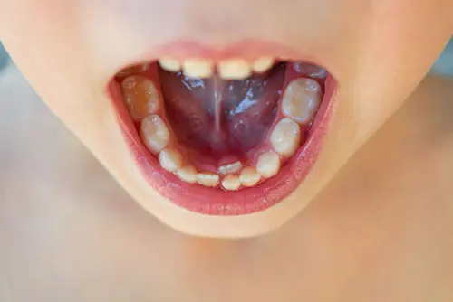 儿童长双排牙怎么治疗，儿童双排牙要立刻拔吗？