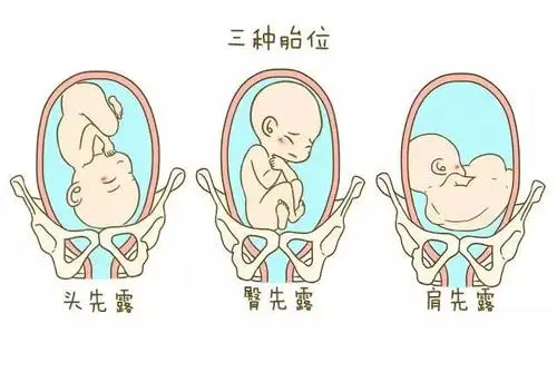 为什么说臀位宝宝发育不健康