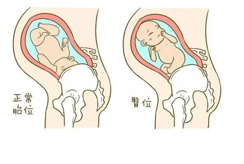胎儿臀位是什么原因造成的
