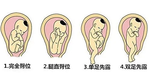 胎儿臀位是什么原因造成的