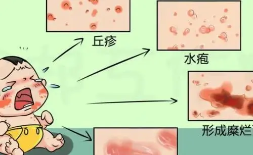 湿疹初期症状是什么样子 湿疹症状类型图片