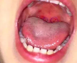 儿童咽喉疱疹初期症状有哪些