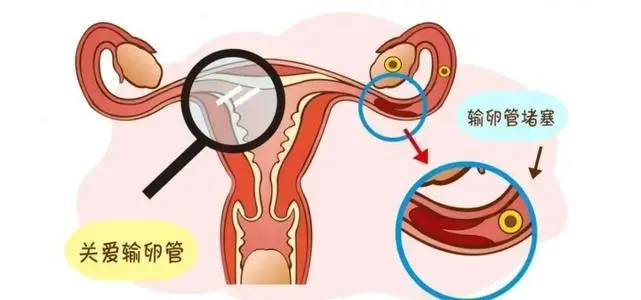 输卵管堵塞有哪些症状表现 输卵管堵塞的5个征兆！