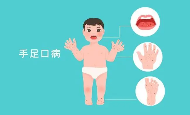 手足口病症状初期图片 教你如何尽早辨别手足口病症