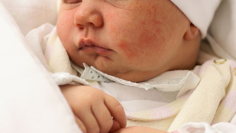 婴儿湿疹怎么好得快 婴儿湿疹快速消退方法