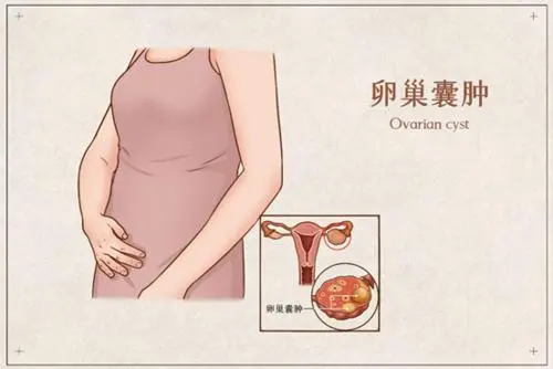 早期卵巢囊肿五大症状