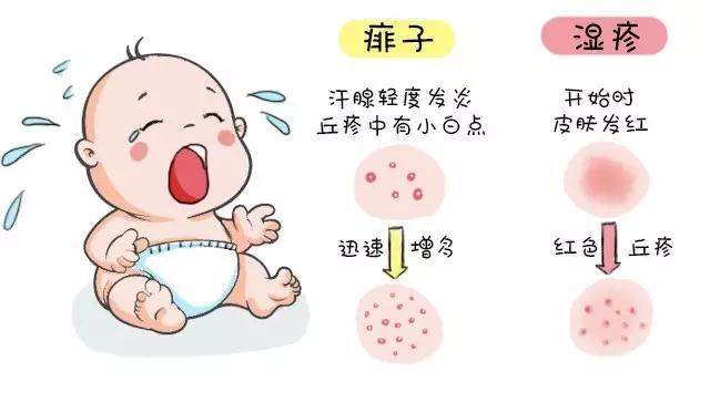 新生儿痱子和湿疹的区别，婴儿湿疹与痱子对比照