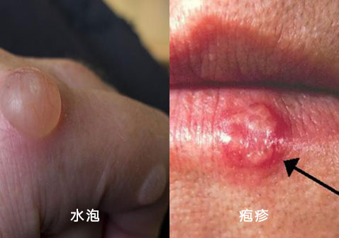 水泡和疱疹的区别，水泡和疱疹的区别图片