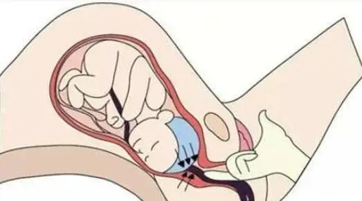 孕妇怎么知道自己开指了 怎么知道产妇开几指