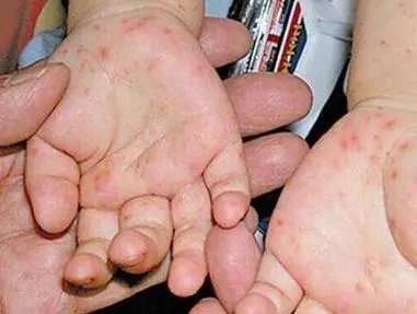 儿童手足口病初期症状图片
