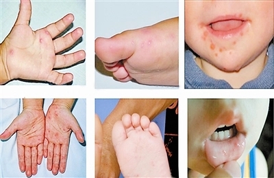 手足口病初期症状二、手足臀上长出红色皮疹