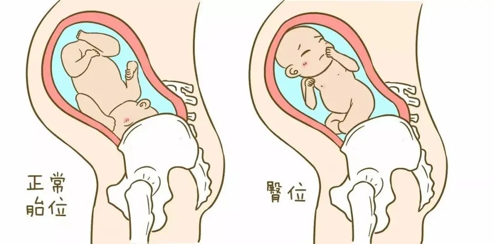 胎位不正是什么原因导致的 胎位不正要注意什么？